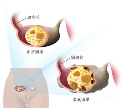 多囊卵巢