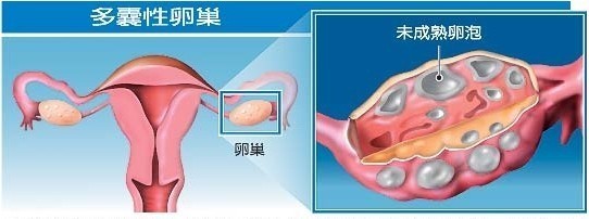 多囊卵巢综合症