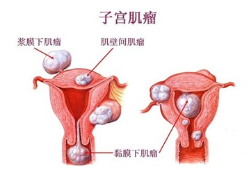 子宫肌瘤