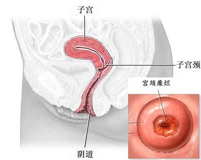 宫颈糜烂