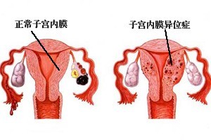 子宫内膜异位症