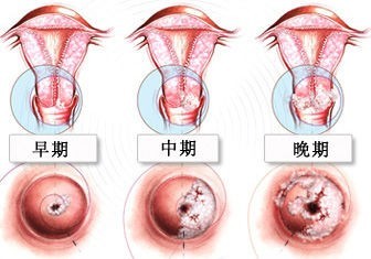 宫颈糜烂