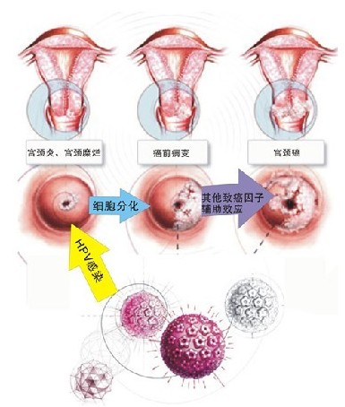 宫颈糜烂