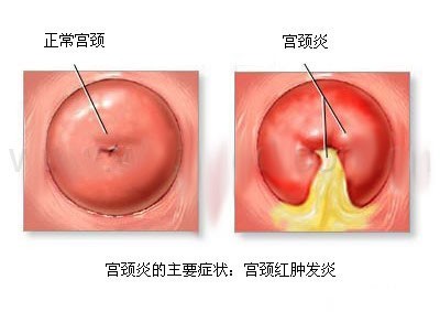 宫颈炎