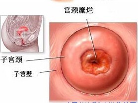 宫颈糜烂