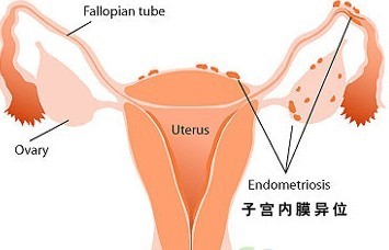 子宫内膜异位症